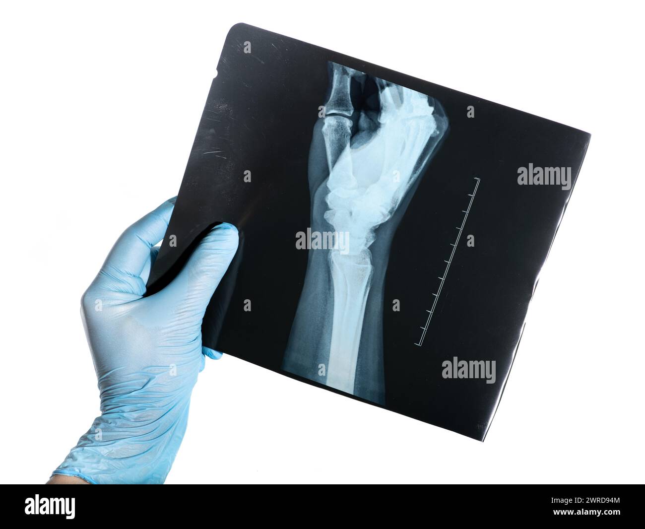 Hand in medical blue glove holds X-ray of the side of a woman`s hand uncommon traumatic wrist injury trauma result Stock Photo